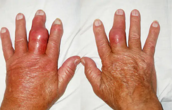 Điều trị gout bằng bài thuốc dân gian