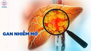 Gan Nhiễm Mỡ